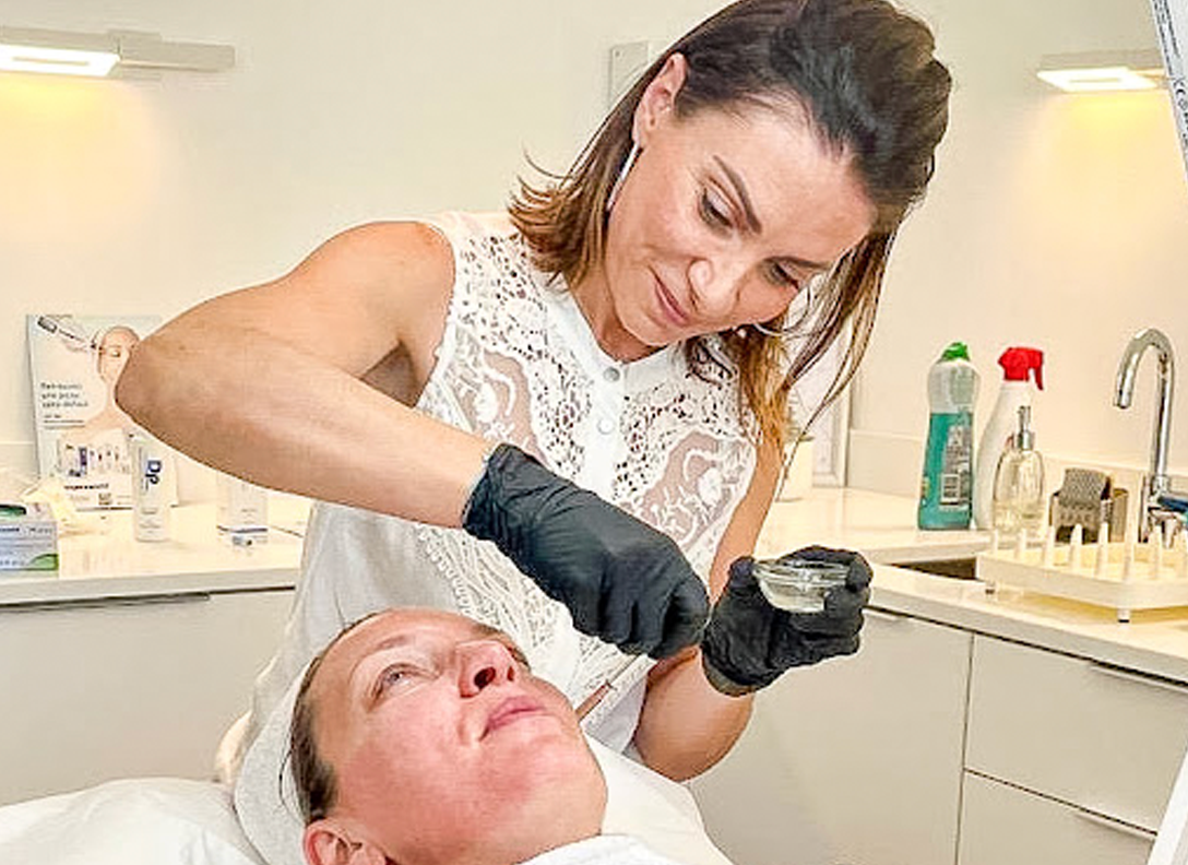 Microneedling