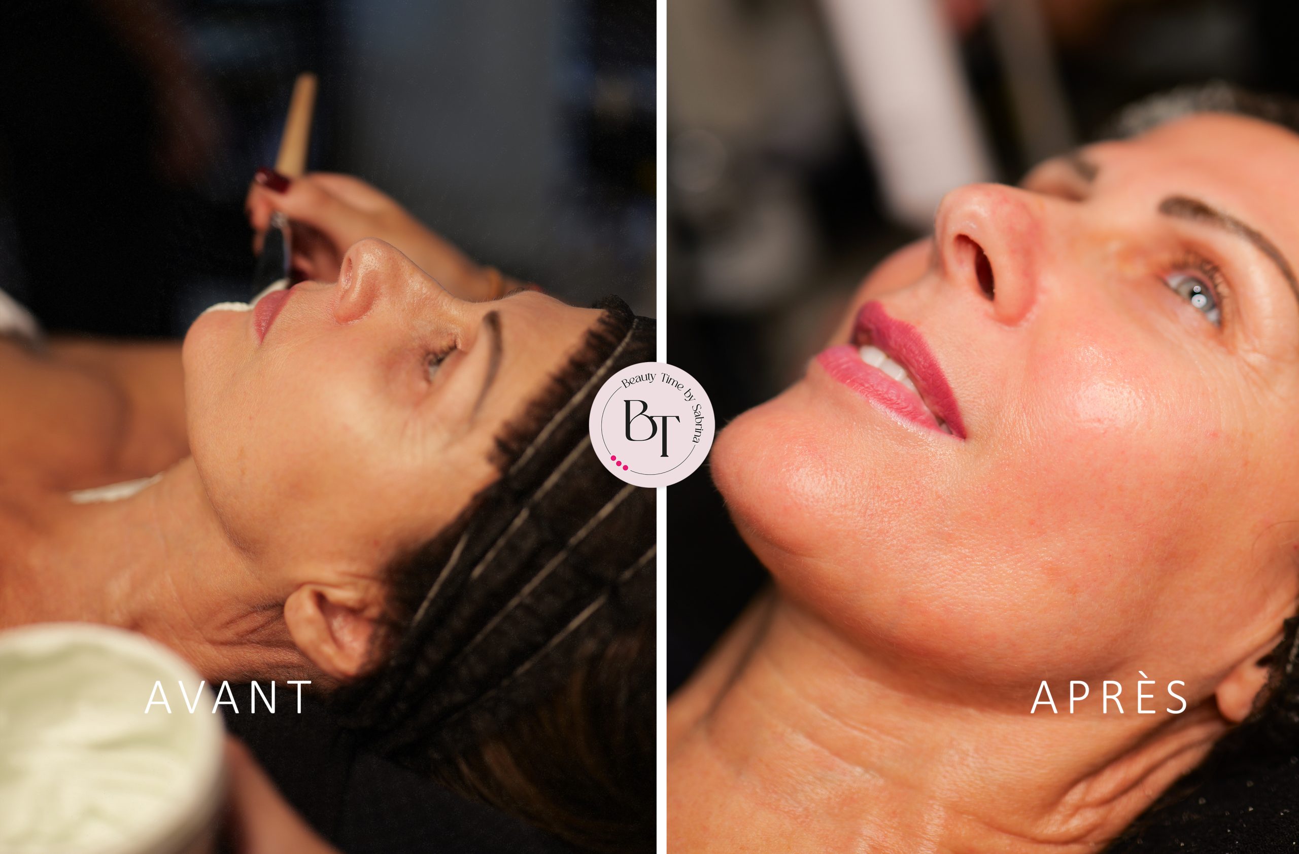 Lifting du visage